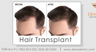 Best hair transplant in Lucknow
