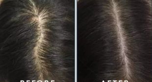 Hair fall treatment in mississauga canada