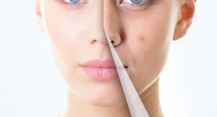Acne Treatment in Mississauga canada