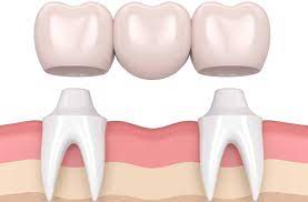 5 Things To Consider Before Having a Dental Bridge